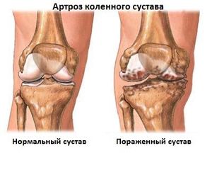 Артроз колена
