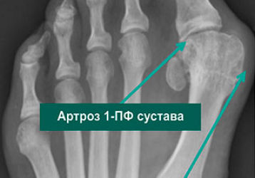 Особенности диагностики и лечения остеоартроза суставов стопы