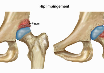 Хирургическая операция для лечения импиджмент-синдрома тазобедренного сустава