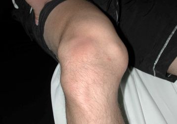 Вывих коленного сустава: симптомы и лечение вывиха колена и коленной чашечки
