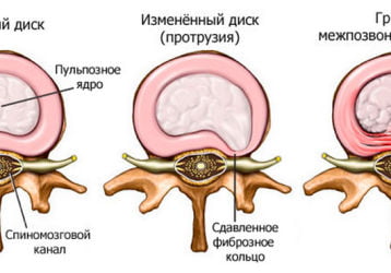 Удаление межпозвоночной грыжи: все о хирургическом лечении