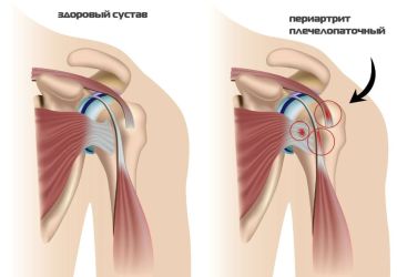 Комплекс лечебных упражнений при плечелопаточном периартрите доктора Попова