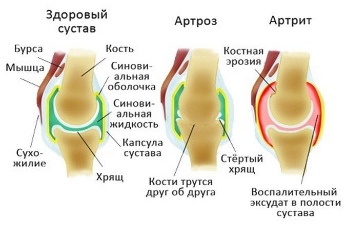 Разница артроза от артрита