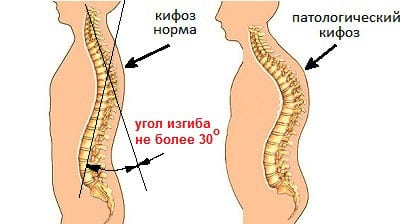 Боли между лопатками