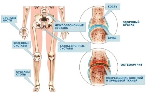 Причина артрита