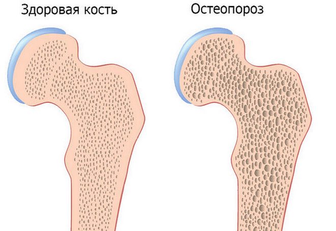 Остеопороз