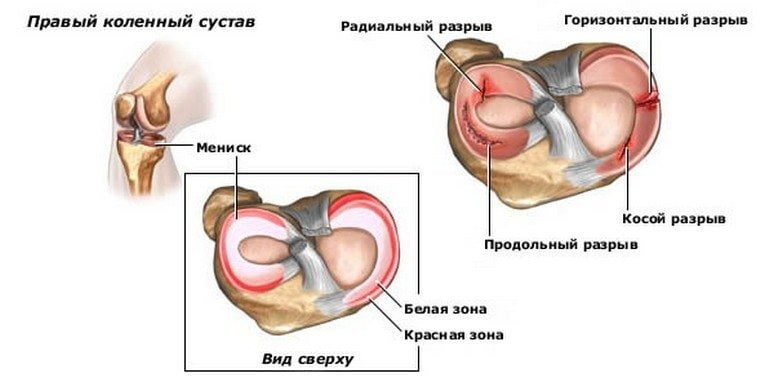 Разрыв мениска