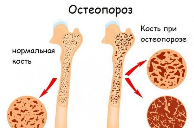 Остеопороз 