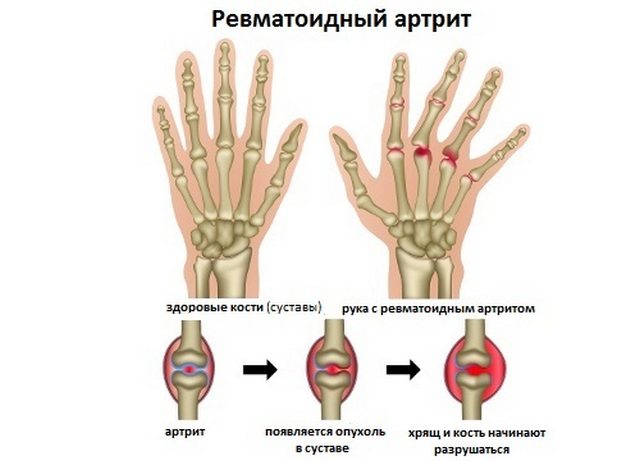 Ревматоидный артрит