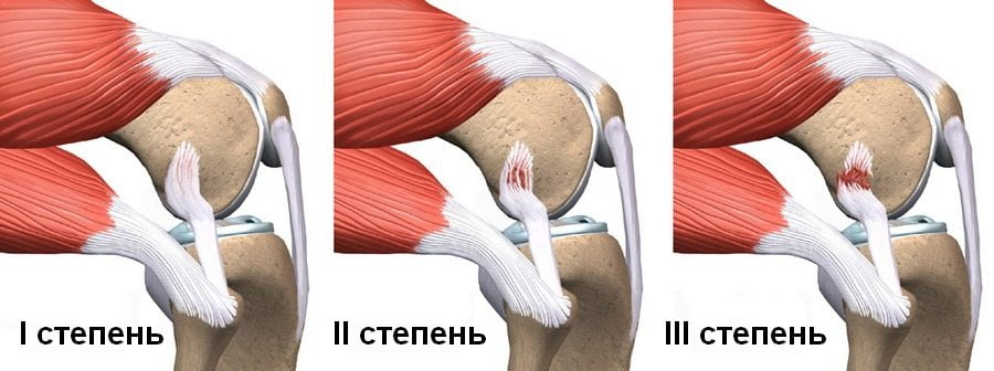 Степени растяжения связок колена 