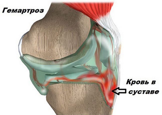 Гемартроз колена 