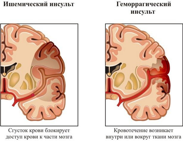 Инсульт 