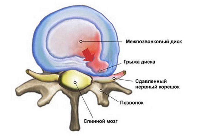 Защемление нервного корешка 