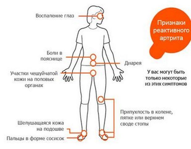 Признаки реактивного артрита