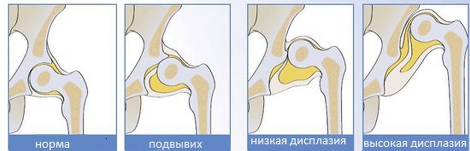 Дисплазия 