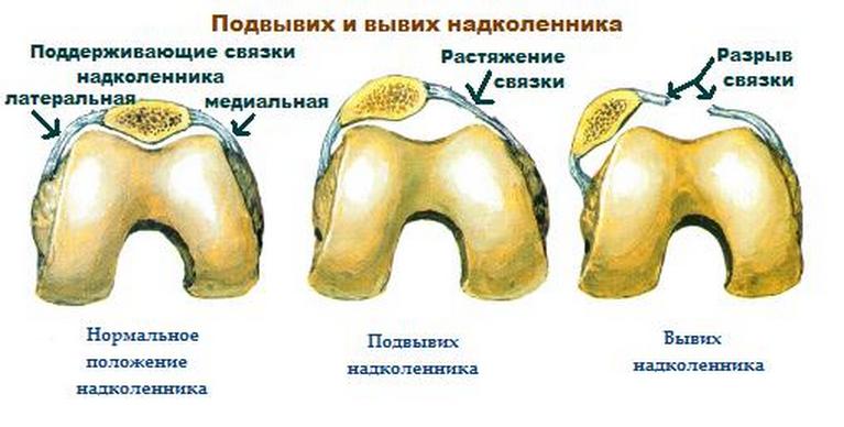 Вывих надколенника