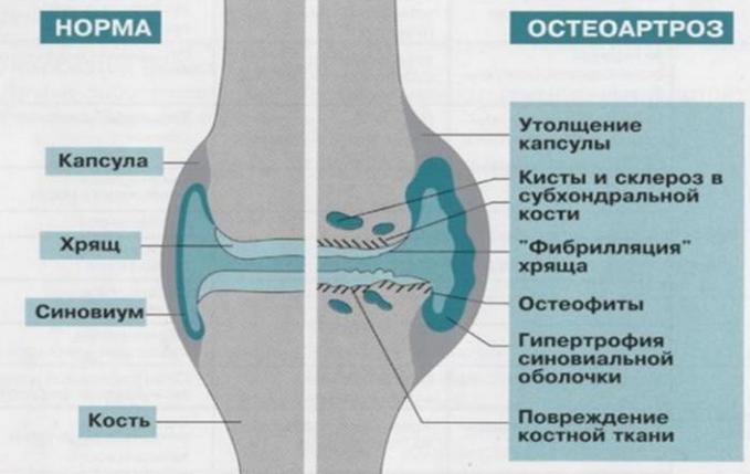 Остеоартроз коленного сустава