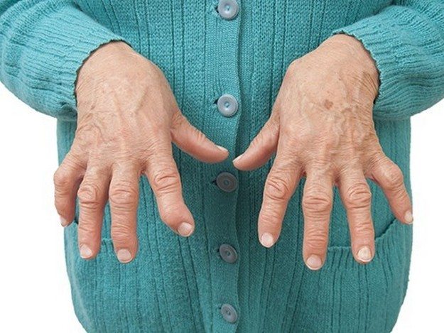 Ревматоидный полиартрит пальцев рук 