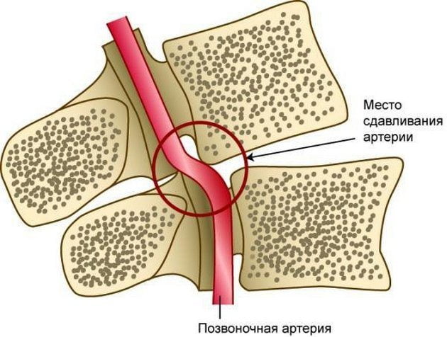 Синдром позвоночной артерии при шейном остеохондрозе симптомы и лечение