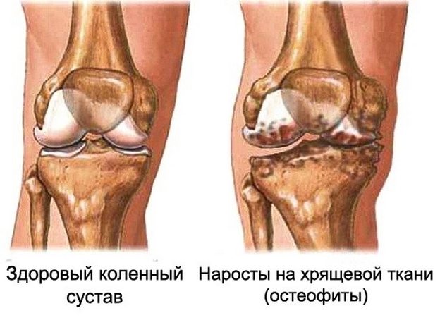 Остеофиты на коленном суставе