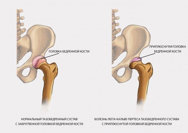 Асептический некроз головки бедренной кости