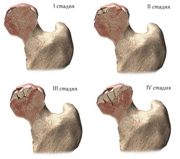Стадии асептического некроза