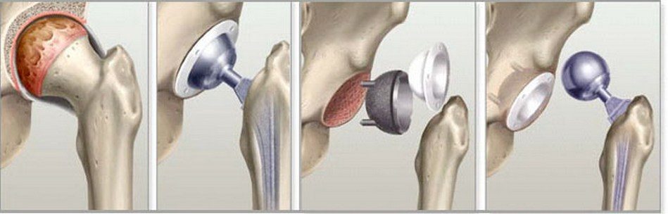 Протезирование тазобедренного сустава