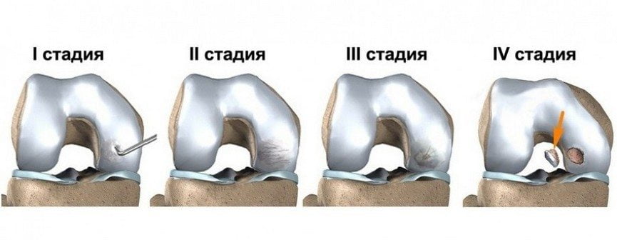 Стадии болезни Кенига