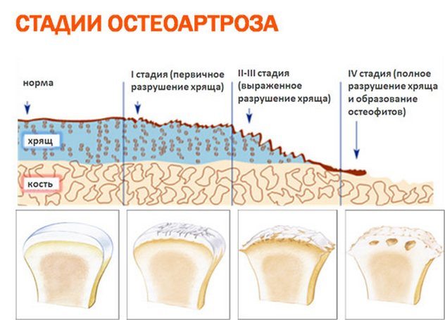 Остеоартроз