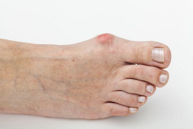 Болит косточка на большом пальце ноги – 6 причин, диагностика и лечение