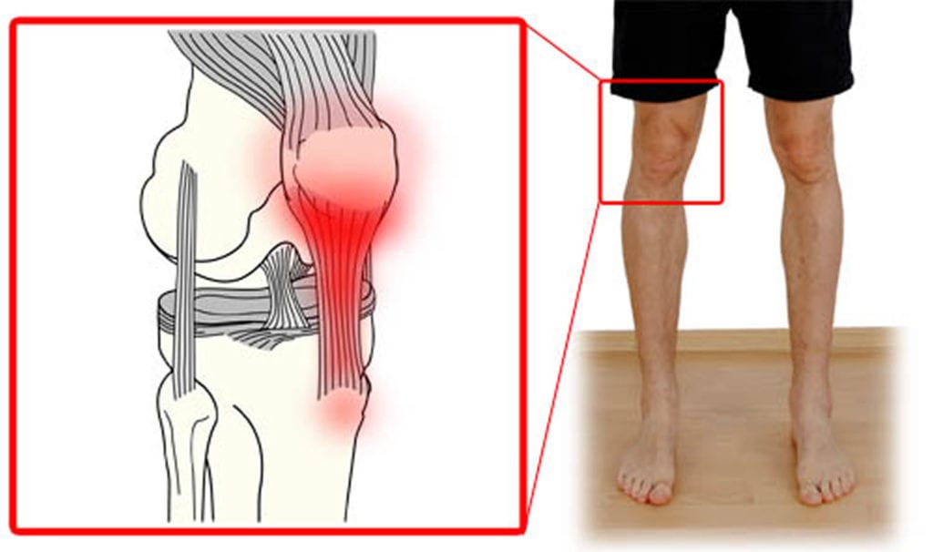 Что делать если ноют колени на погоду симптомы и признаки заболеваний