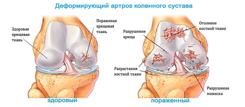 Деформирующий артроз коленного сустава