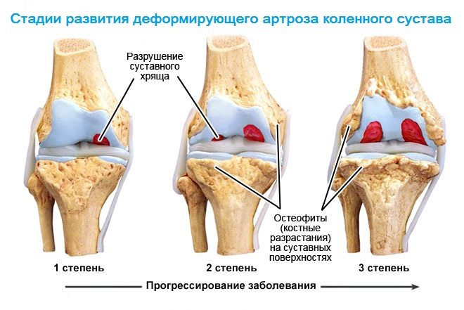 Стадии развития деформирующего артроза