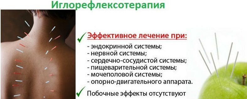 Иглорефлексотерапия