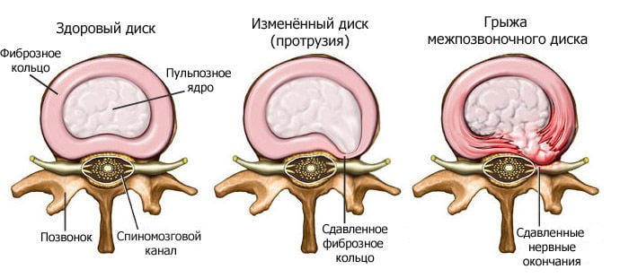 Межпозвоночная грыжа