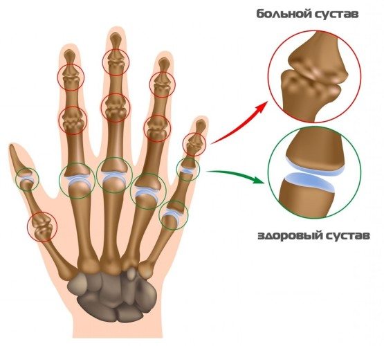 Суставы кисти рук