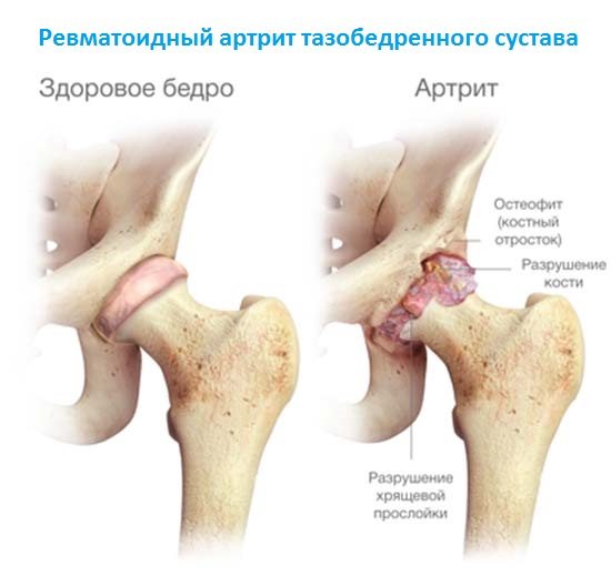 Ревматоидный артрит тазобедренного сустава