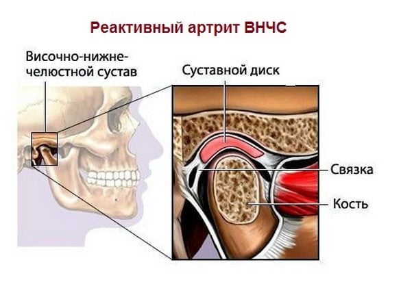 Реактивный артрит ВНЧС