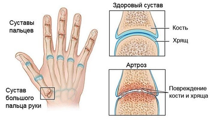 Остеоартроз кистей рук: лечение деформирующего полиостеоартроза суставов пальцев рук 1, 2 и 3 степени