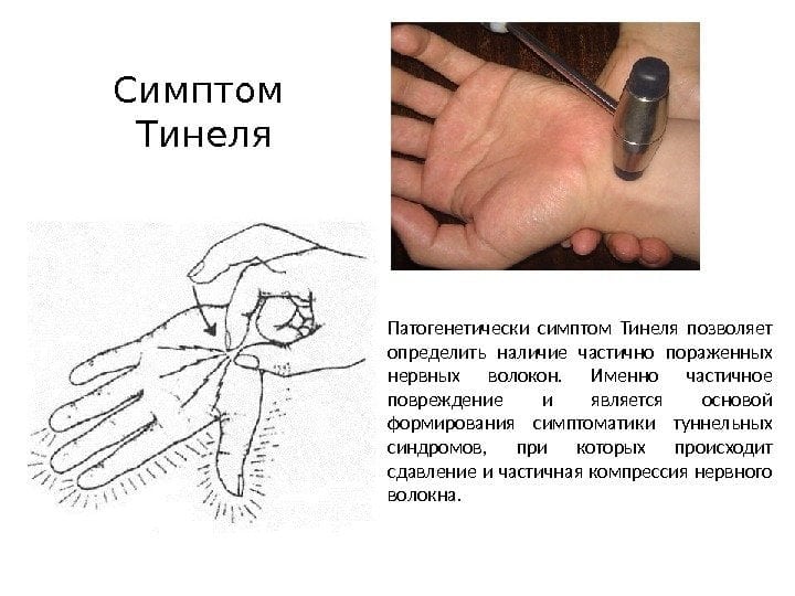 Эпикондилит локтевого сустава