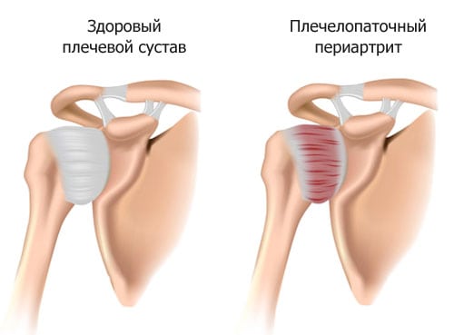 Хруст в плечевом суставе при вращении лечение