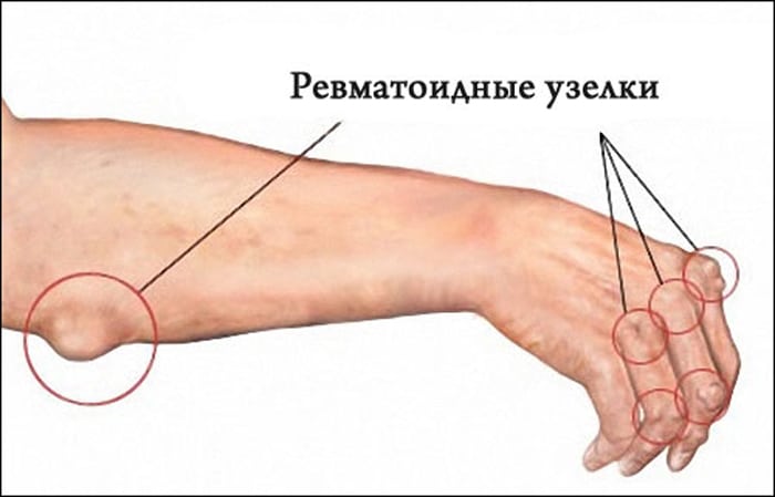 Причина артрита