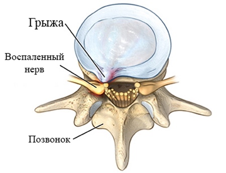 Радикулопатия