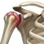 Артрит плечевого сустава: причины, симптомы и как лечить