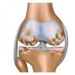 Гонартроз коленного сустава 2 степени: причины, симптомы и лечение