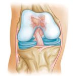 Пателлофеморальный артроз коленного сустава: степени, симптомы и лечение