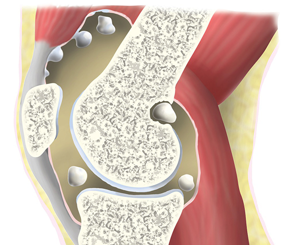 Хондроматоз коленного сустава