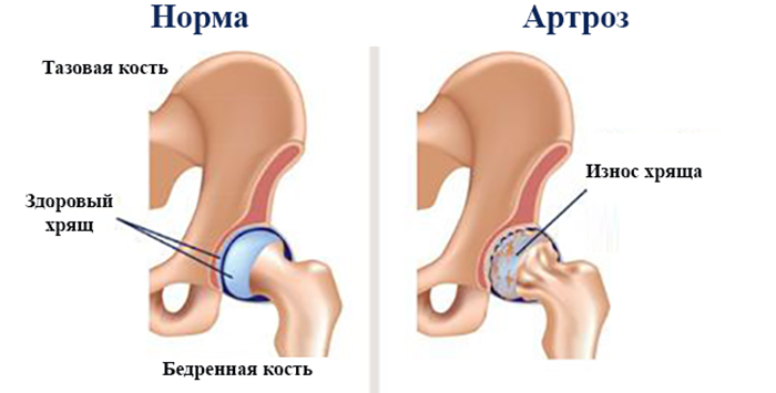 Норма и артроз