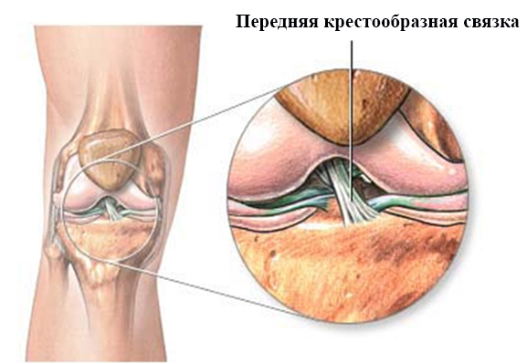 Как выглядит передняя крестообразная связка