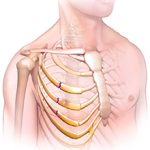 Перелом рёбер: симптомы, последствия и лечение